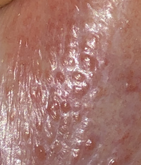 閲覧注意亀頭に謎の赤いぶつぶつができていたのですがこれはなんですか も Yahoo 知恵袋