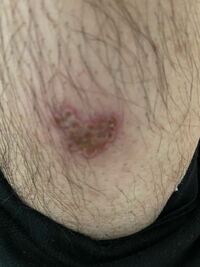 気持ち悪い画像を申し訳ありません 2週間前に足のふくらはぎが痒くてかい Yahoo 知恵袋