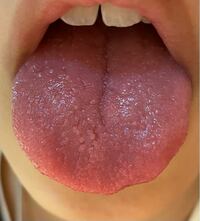 する ヒリヒリ 病気 が 舌 ～舌が乾く、口が渇く～【舌が痛い.com】症状について