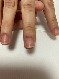 ネイル検定3級を受けるのですが この指の皮膚は疾患になります Yahoo 知恵袋