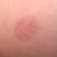 朝起きたら皮膚にこのような丸い跡 がありました 胸元なのですが Yahoo 知恵袋