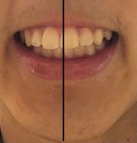 非抜歯の矯正が終了しました 矯正前より奥歯の噛み合わせはよくなっ Yahoo 知恵袋