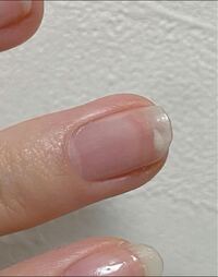 爪白い斑点 数日前からこのような白いものができました 取 Yahoo 知恵袋