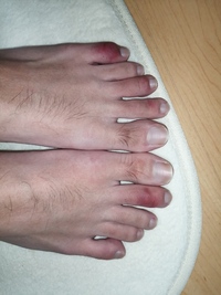 足の指が赤く腫れていてしもやけかと思って薬を三日間塗っているのですが三 Yahoo 知恵袋
