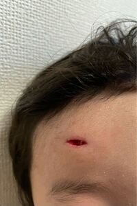 3歳の子どもが階段で頭を打ってけがをしました しばらく出血してい Yahoo 知恵袋