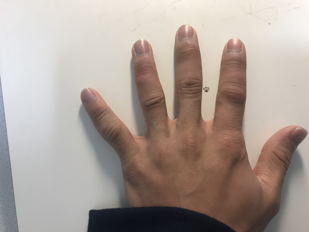左手の人差し指だけ腫れぼったく、曲げると痛いです。この病気は 
