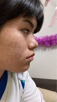 最近とても悩んでいます 私は口ゴボですか それともたらこ唇でしょうか Yahoo 知恵袋