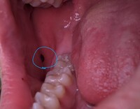 Apictnyohgwnb 50 陰嚢 血豆 陰嚢 血豆 痛い