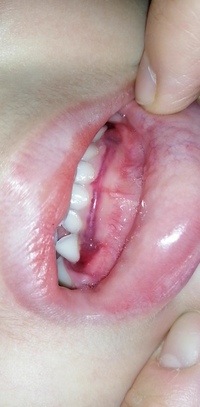 今朝起きたら2歳8カ月の娘の歯茎がこんなことになっていました 昨 Yahoo 知恵袋