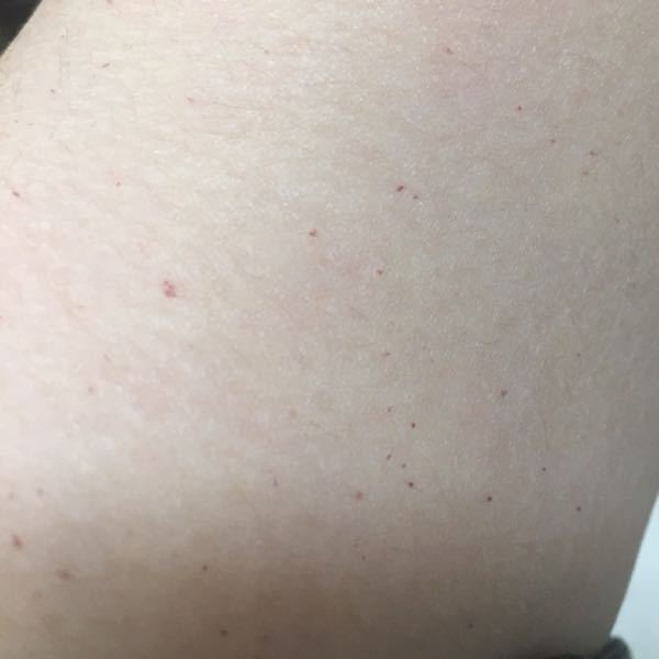 皮膚の赤い斑点についてお聞きしたいです 私は子供の頃か Yahoo 知恵袋