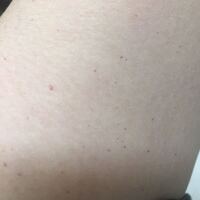 皮膚の赤い斑点についてお聞きしたいです 私は子供の頃か Yahoo 知恵袋