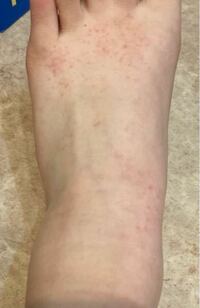 の 甲 赤い 斑点 足 足に赤い斑点ができるのは病気？対処方法も紹介！