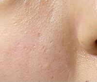 閲覧注意です 肌が汚くてコンプレックスですクレー Yahoo 知恵袋