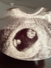 双子ご出産された方 教えてください 昨日 約7週の妊婦 Yahoo 知恵袋