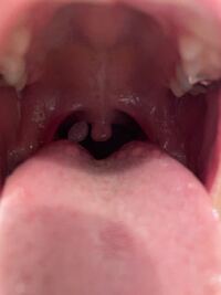 のどちんこ 血豆 口の中に血豆が突然できた 知っておくべき３つの原因 Documents Openideo Com