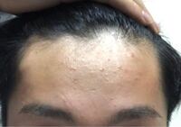 このおでこはハゲの前兆ですか 父型の祖父は禿げていて父 Yahoo 知恵袋