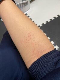画像あり さっき気づいたんですけど 写真通り片腕に赤い湿疹 があ Yahoo 知恵袋