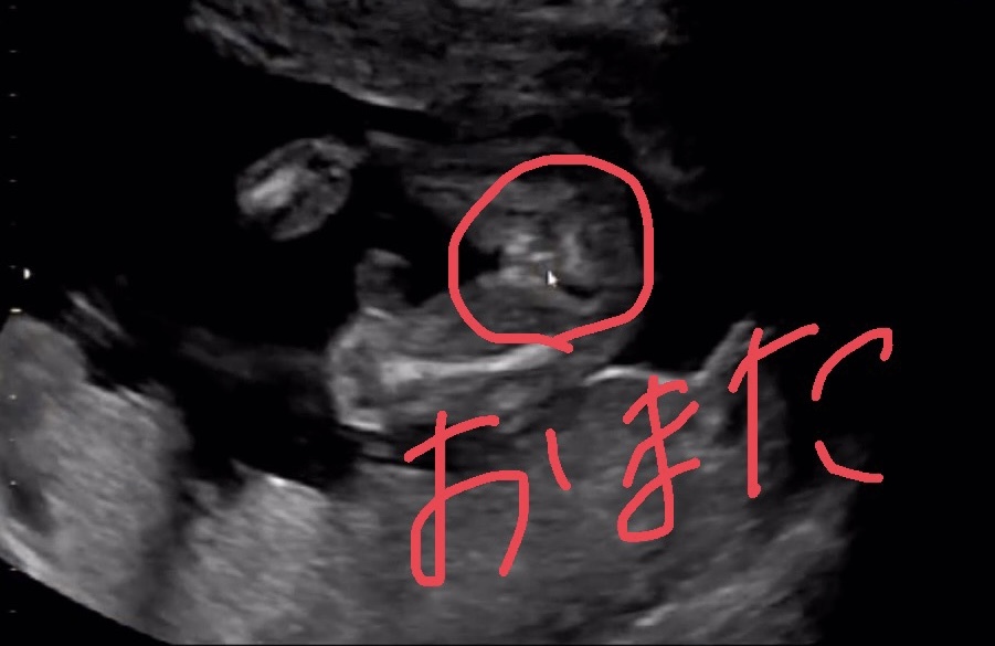 エコーの性別について 17w3d の検診にて女の子の可能性が高いけどシ Yahoo 知恵袋