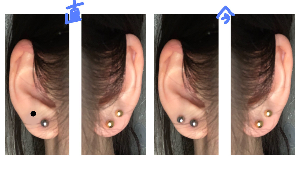 4日前に病院でピアスを両耳2つずつ計4つ開けました。しかし、自分の 