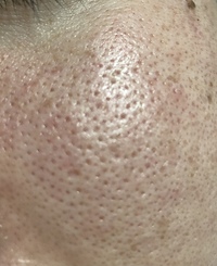 この毛穴はどうしたら治りますか？
油っぽく顔の全体がこのような毛穴が開いた状態です。
男21歳です。アドバイスお願いします。 