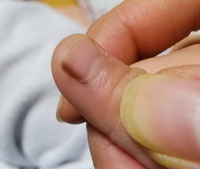 数ヶ月前から4歳の子供の爪に黒い線があるのに気づきました 黒い線 癌 Yahoo 知恵袋