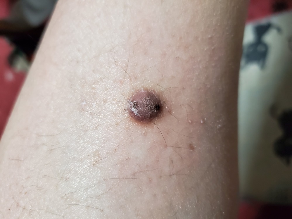 すみません。以前からカサブタが出来ていて、何度も剥がしていたのです 