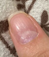 数年前から 爪の表面がボコボコ カサカサになっています 初めは片手の小 Yahoo 知恵袋