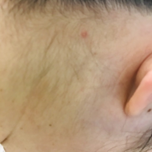 頭皮 帯状 疱疹 痛みに注意！頭皮にできる帯状疱疹とは。治療時の脱毛についても解説
