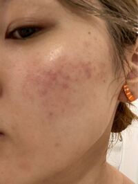 肌の赤みと毛穴が無くなりません ビタミンc 皮膚科 クレイは試しました Yahoo 知恵袋