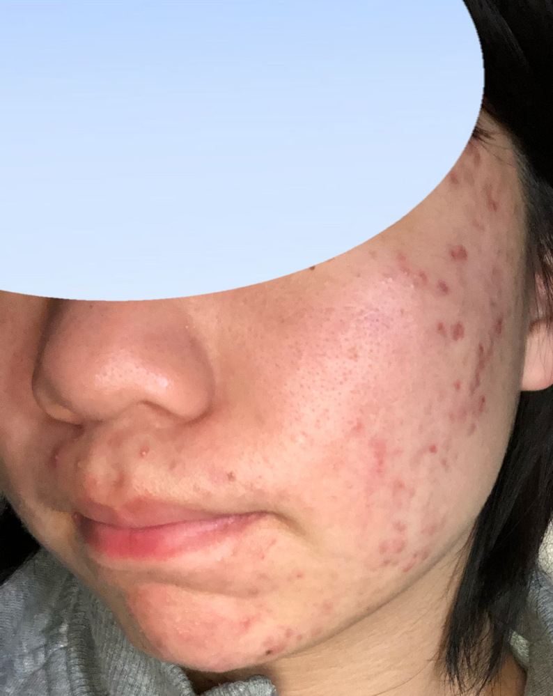 閲覧注意 ニキビ肌の写真ありですお見苦しい写真すみませんあまり回答が Yahoo 知恵袋