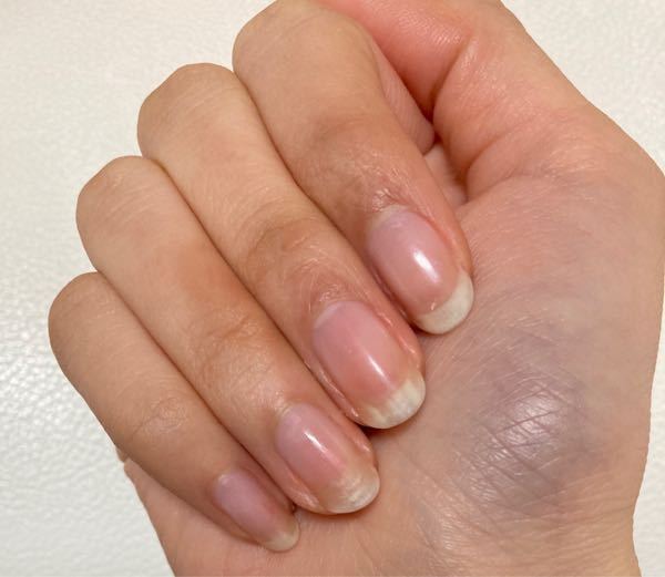 爪甲剥離でしょうか ２ヶ月前からネイルベッドが狭まってきているな Yahoo 知恵袋