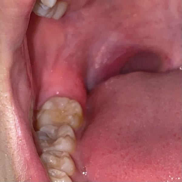奥歯の歯茎？が腫れてて痛いんですけどこれって親知らずですかね 