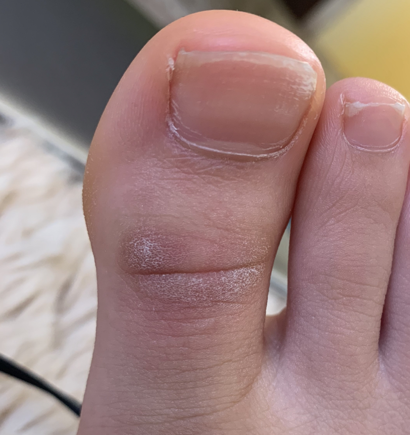 水虫 投票受付中の質問 Yahoo 知恵袋