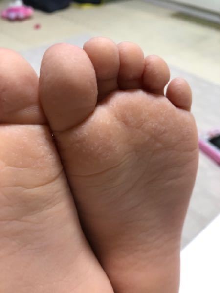 水虫 解決済みの質問 Yahoo 知恵袋