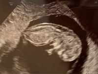 胎児浮腫について 現在11w1dの代前半妊婦です 本日のエコ Yahoo 知恵袋