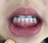 3歳の娘の歯茎が黒というか茶色というか そのような色 Yahoo 知恵袋