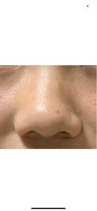 この鼻はヒアルロン酸注入したら鼻筋が出来ますか できます Yahoo 知恵袋