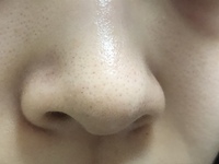 鼻と頬の黒ずみがやばいです Duoの黄色を使ってみようと思ってるので Yahoo 知恵袋