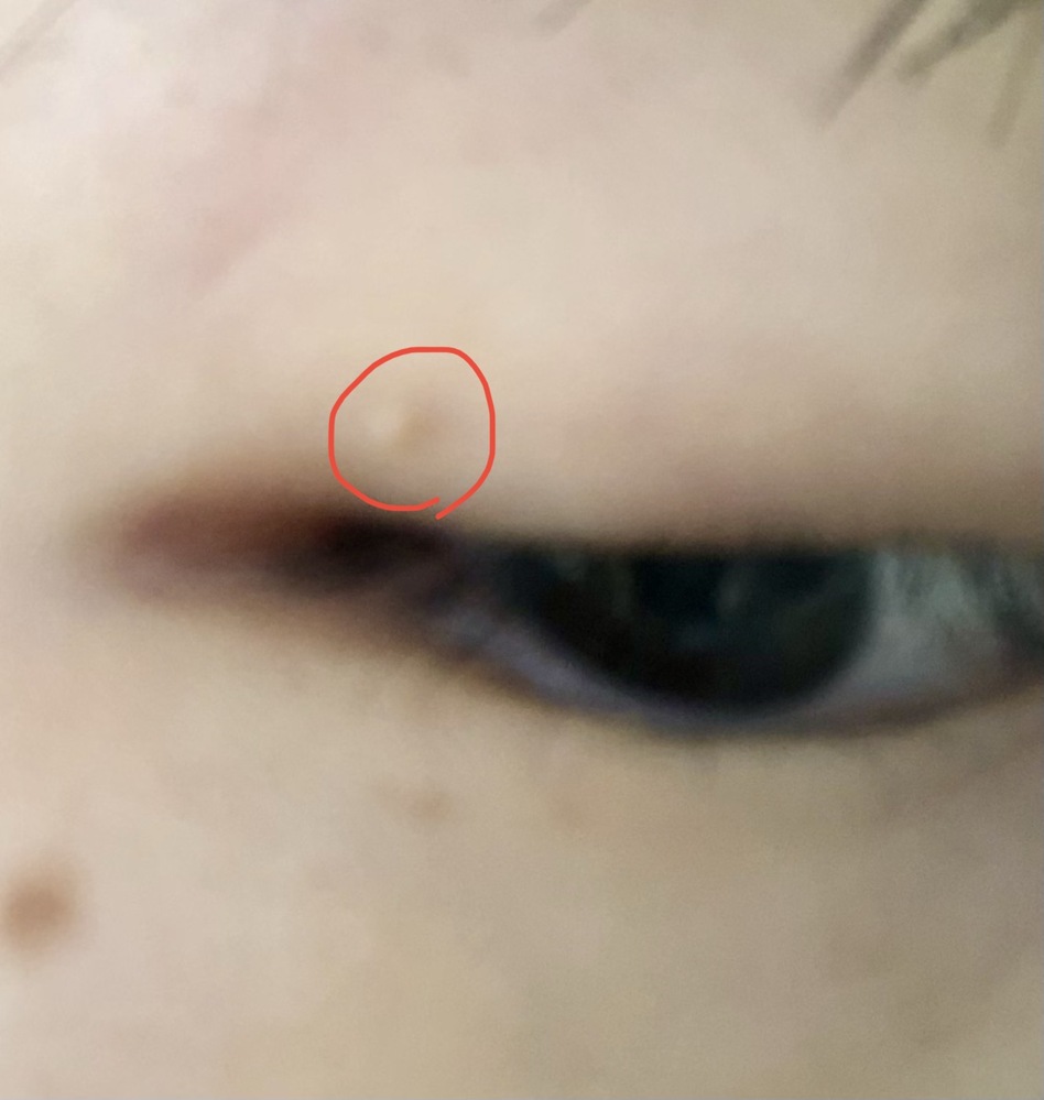 こんにちは。まぶたの上に赤いできものができました。やはり皮膚科... - Yahoo!知恵袋
