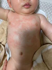 生後4ヶ月の息子がいます 年末に首のあたりが赤くなっていたの Yahoo 知恵袋