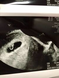 初めて妊娠しました 胎嚢と心拍確認できたのですがエコー写真の見方 Yahoo 知恵袋