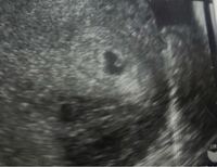 現在妊娠4週5日です この胎嚢の中に見えるのは卵黄嚢で Yahoo 知恵袋
