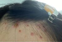 汚い写真失礼します 3ヶ月前ほどから前髪の生え際に沢山ニキビ Yahoo 知恵袋