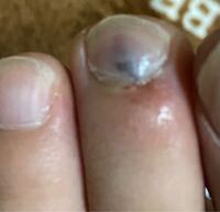 今日足の指をぶつけてしまって爪を見たらこんなふうになっていま Yahoo 知恵袋