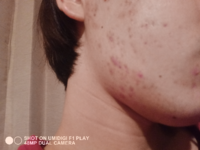 画像汚くてすみません ニキビ跡や毛穴の開きについて質問です Yahoo 知恵袋