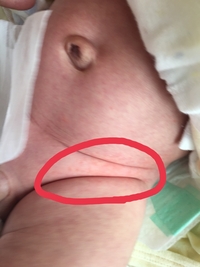 生後1ヶ月半の赤ちゃん足の付け根の赤みとぷつぷつ画像あります 赤ち Yahoo 知恵袋