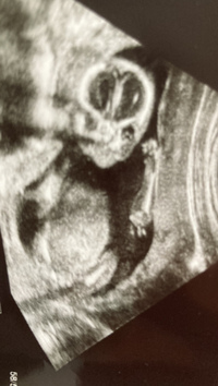 エコー写真について 17週目の初妊婦です 今日性別が分かるかも Yahoo 知恵袋
