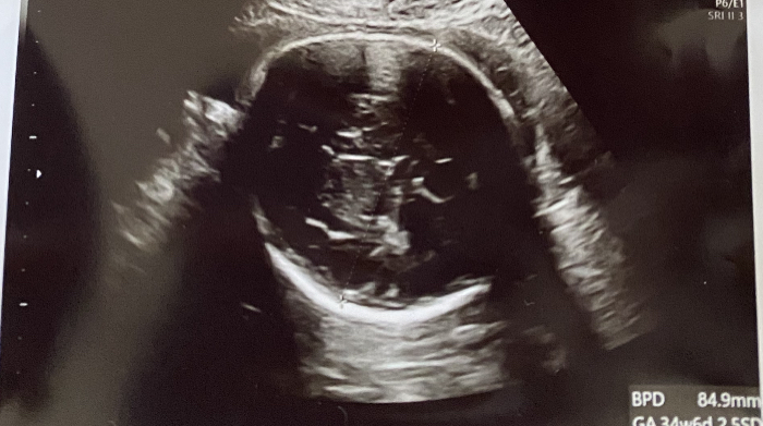 胎児のbpdについてです 30w4dの26歳初産です Bpd Yahoo 知恵袋
