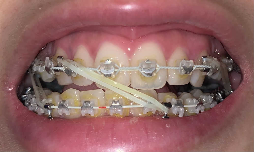 歯列矯正表側のゴム掛けについてです 正中を合わせるために前側 Yahoo 知恵袋