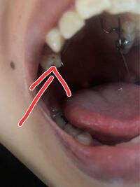 先日矯正の為歯を抜歯しました すると隣の歯の側面に黒い点があ Yahoo 知恵袋